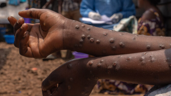WELL-MPOX-QUESTIONS1-hcqt-videoSixteenByNineJumbo1600